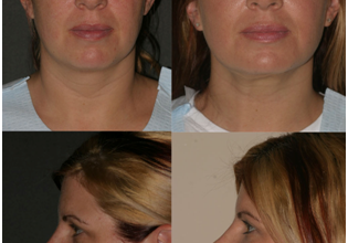 How to get rid of neck fat? Some important tips and exercises for losing neck fats.